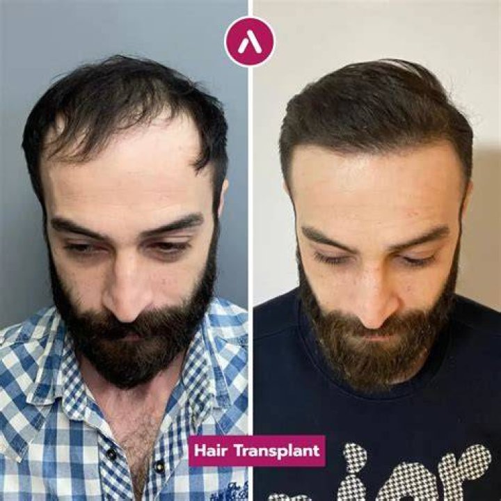 28+ will hair transplant AronsAramina