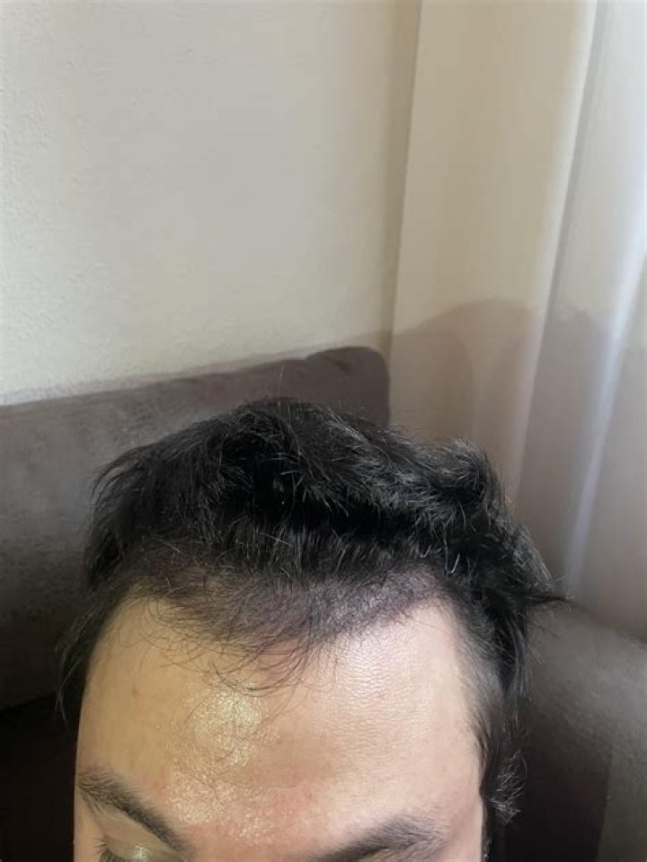 4 Month Update Dr. Pekiner 3,305 grafts r/HairTransplants