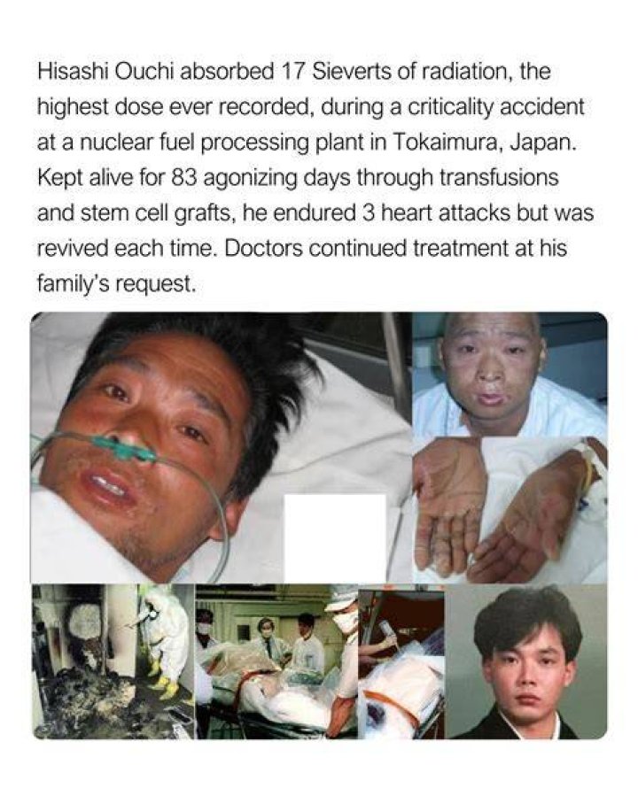 83 Days Of Hisashi Ouchi: A Deep Dive Into One Of History's Most Tragic Medical Cases