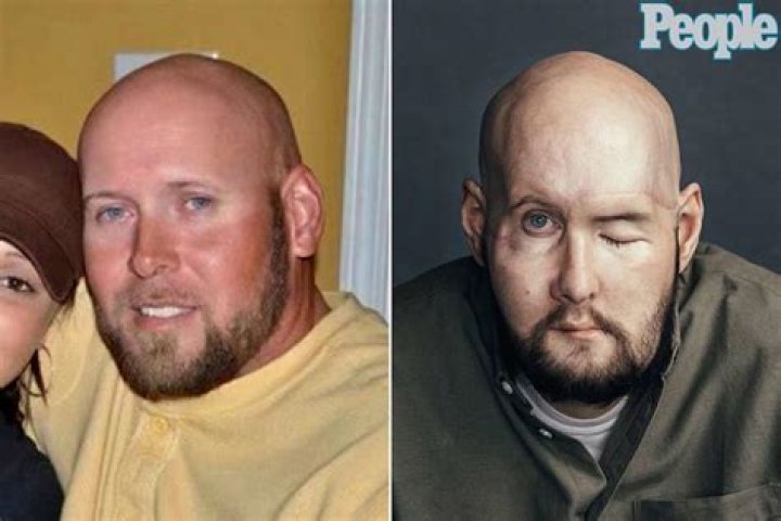 Aaron James before and after his high-voltage electricity accident and after a facial and eye transplant. Photo / AP