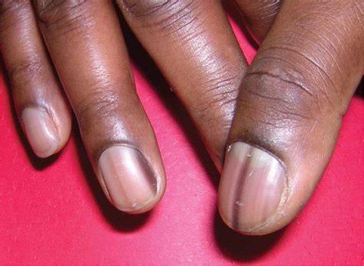 black line down fingernail