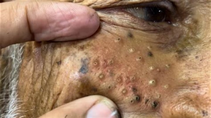 Blackhead Removal On Elderly - Statcare