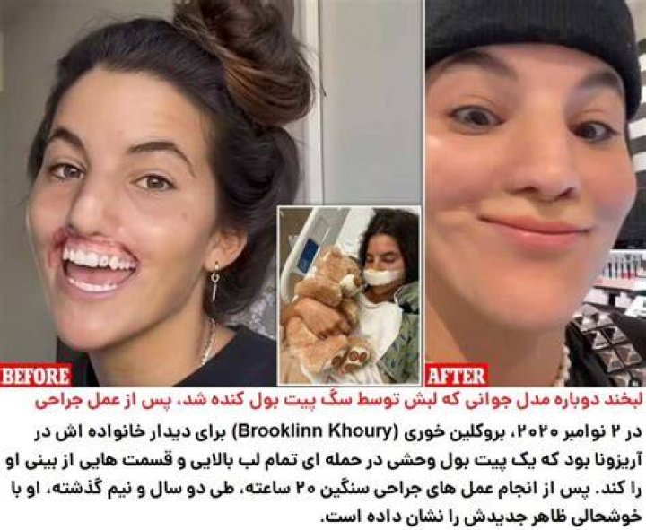 Brook Khoury: Skateboarder and model shares transformation photos after pit bull mauled her face