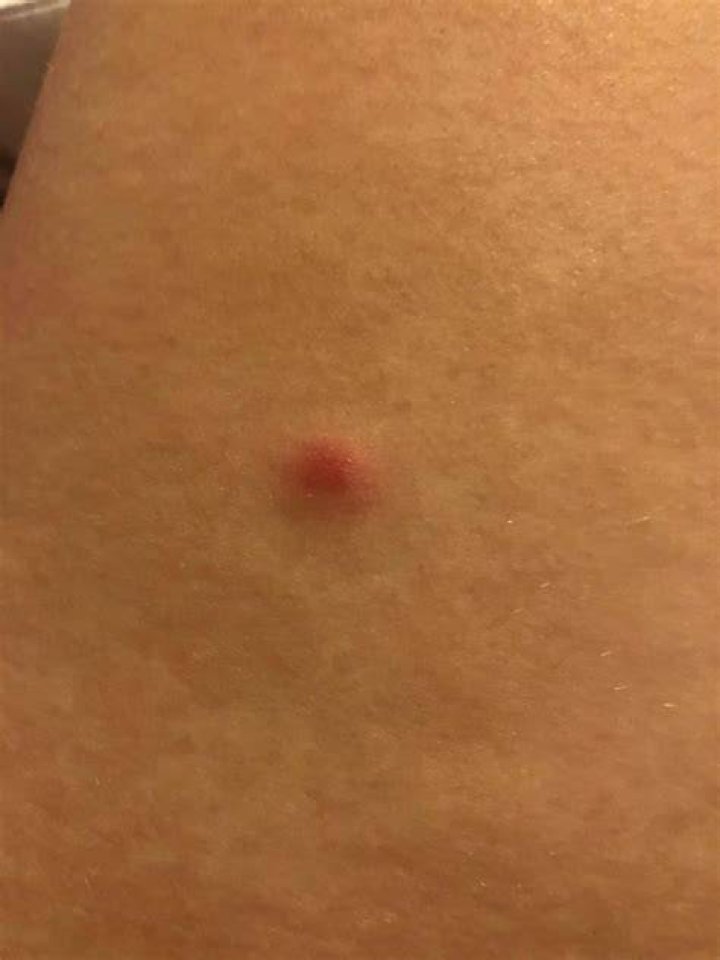Bug Bite or Ingrown Hair
