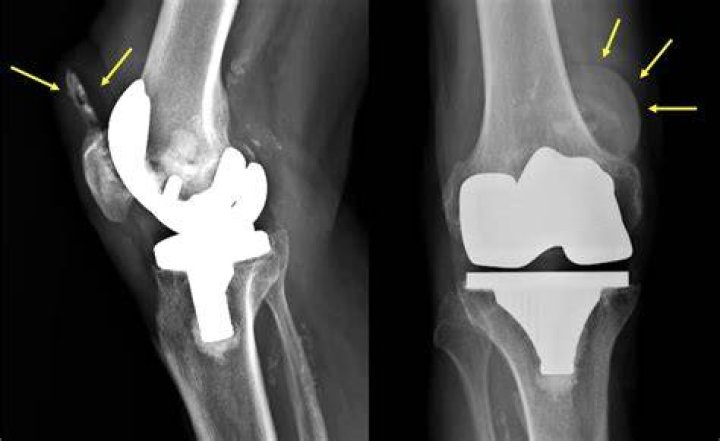 Calcification After Total Knee Replacement