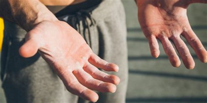 Callused hands from the gym