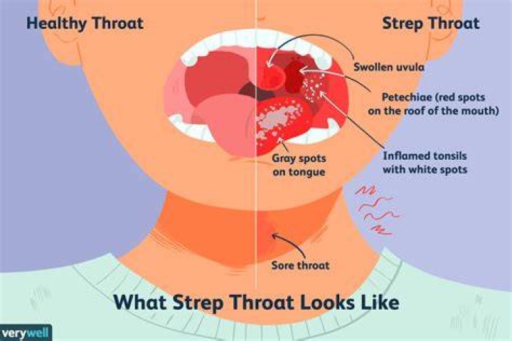 Can I Go Swimming With Strep Throat