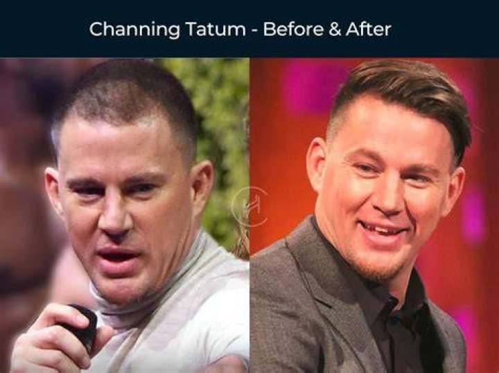 Channing Tatum Hair Transplant The Untold Transformation Tale