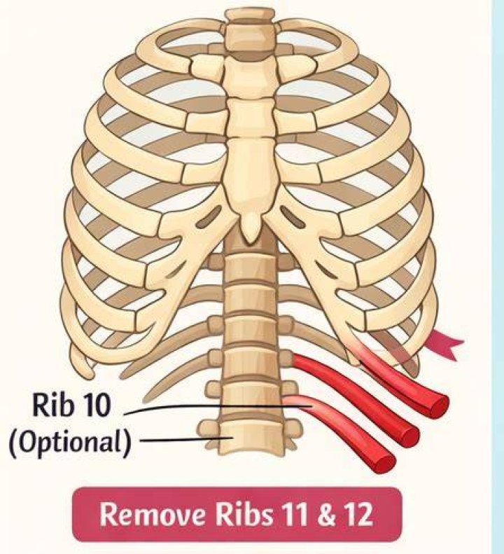 Clinical in Rib Removal Surgery for Waistline Reduction