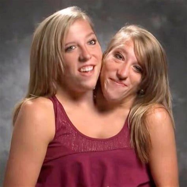 Conjoined Twins Abby and Brittany&rsquo;s Exciting News!