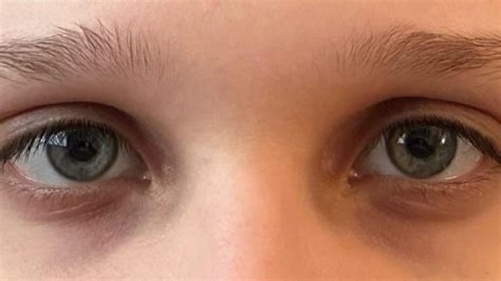 Darkness In Corner Of Eyes Near Nose