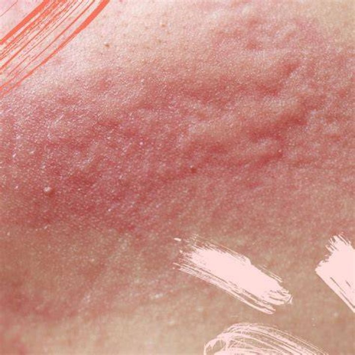 deodorant rash