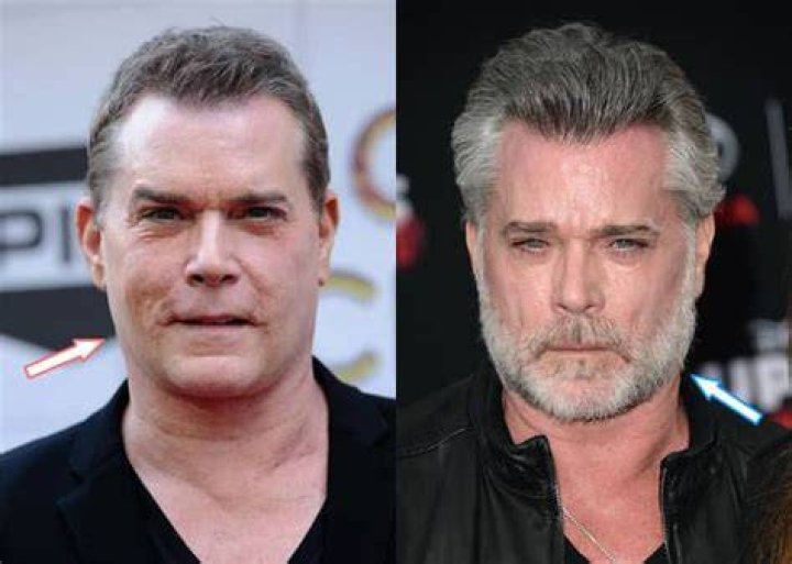 Did Ray Liotta Have Acne? The Truth Behind the Actor's Skin Condition