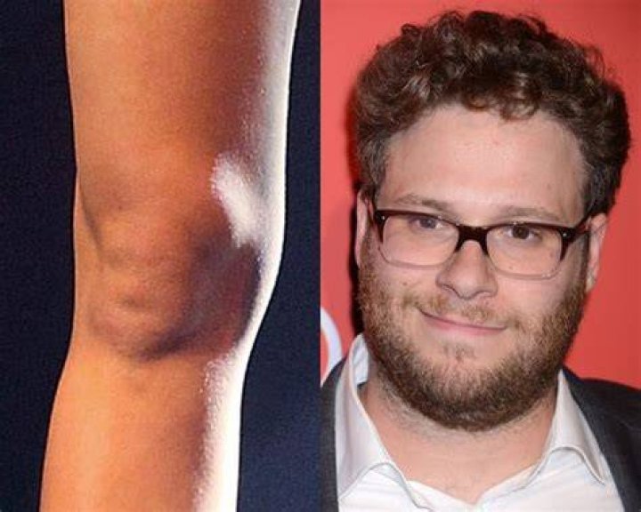Does Miley Cyrus' Knee Look Like Seth Rogen?!