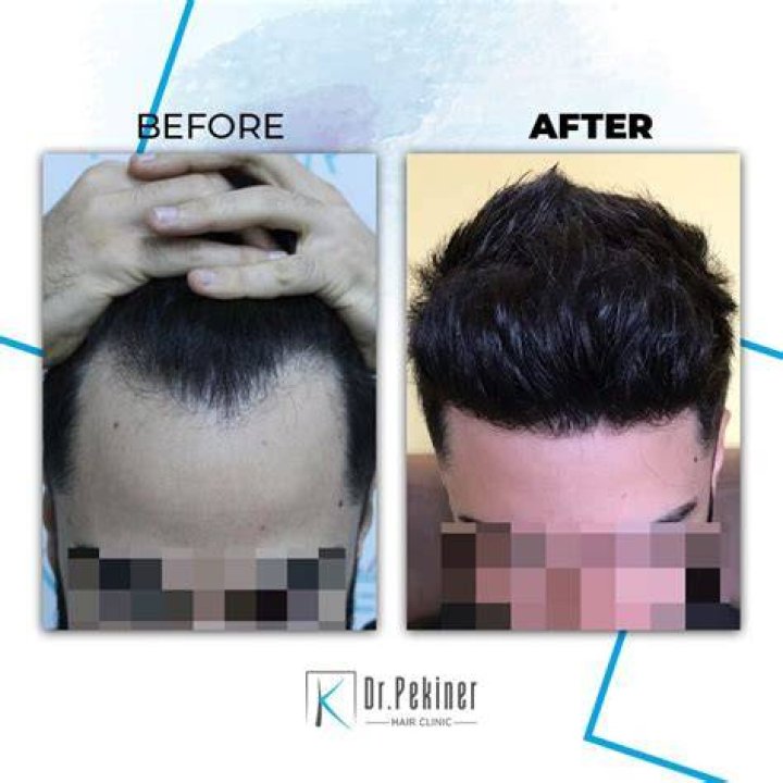 Dr. Kaan Pekiner 3,009 Grafts FUE 2/25/22 Hair Transplant Reviews