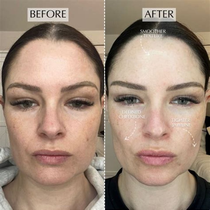 Halo Facial Toning Device