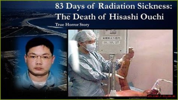 Hisashi Ouchi Final Photo: A Tragic Story Of Suffering And Survival