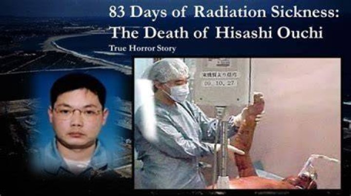 Hisashi Ouchi: The Tragic Story Of A Radiation Victim