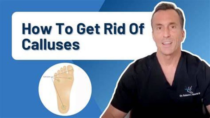 How to Get Rid of Calluses From Lifting