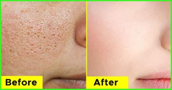 How to get rid of pores