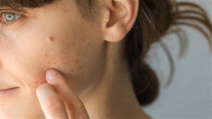 Is There A Link Between Taking Biotin And Getting Acne?