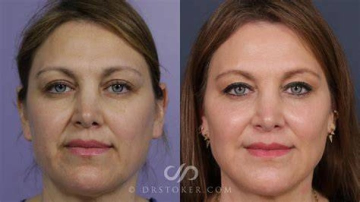 Juvedérm facial fillers case study Juvedérm facial fillers case study