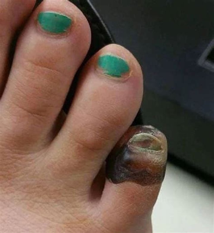Kaylah Branch almost lost her toe over a spider bite
