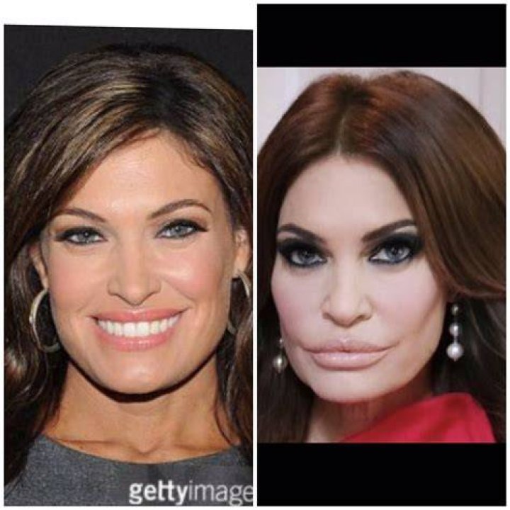 Kimberly Guilfoyle's Plastic Surgery Photos: Before And After Transformation