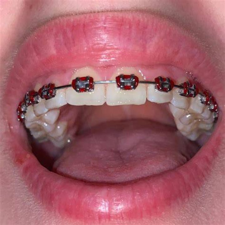 lips with brace or without? r/braceface