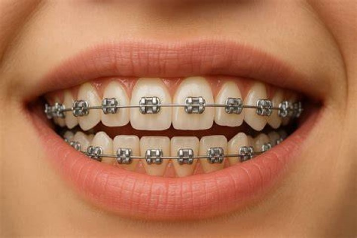one more yr of braces 🤭 r/braceface