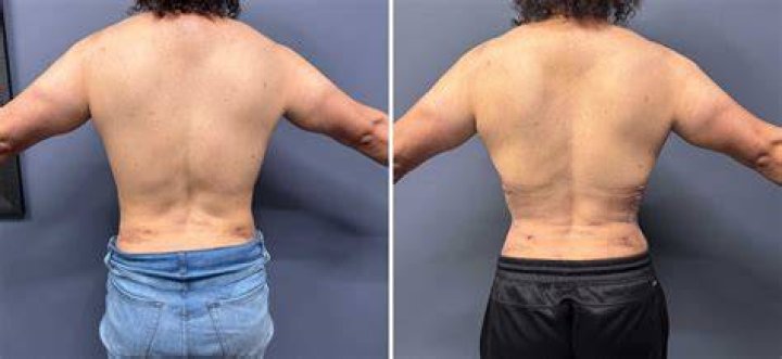 Posterior Rib Removal for Waistline reduction incision markings Dr