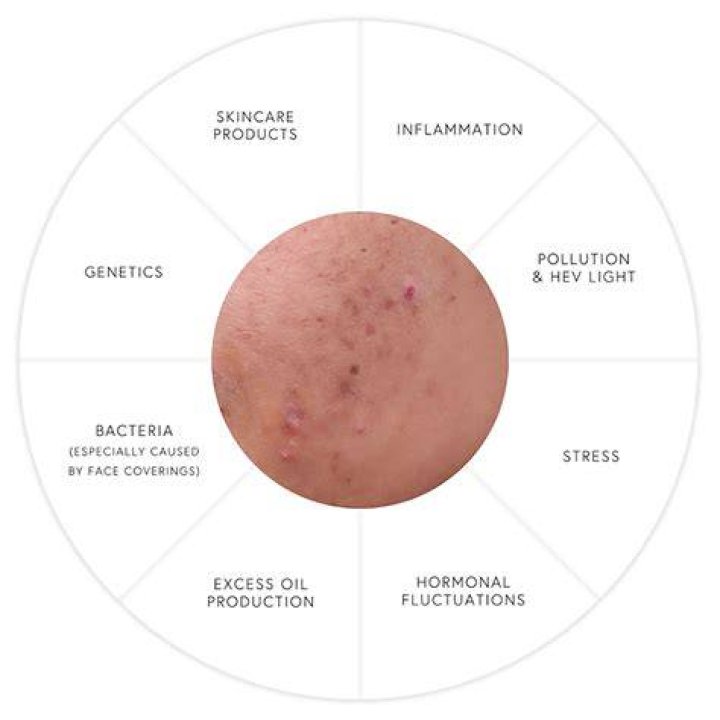 preview for #SkinSchool: Adult acne causes and treatments