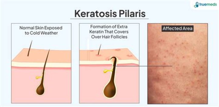 preview for #SkinSchool: Keratosis pilaris (KP) causes and treatments