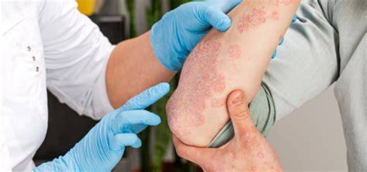 psoriasis treatment