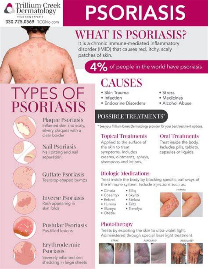 Psoriasis types, causes and treatments
