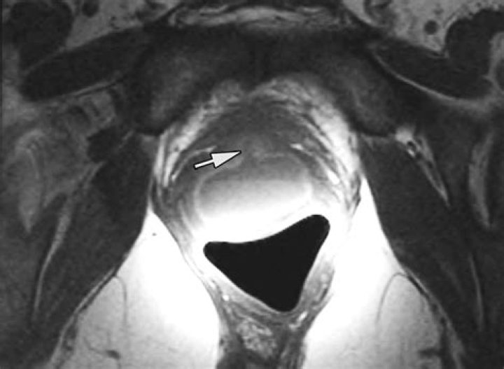 Pulled Hair Out Of Urethra Female
