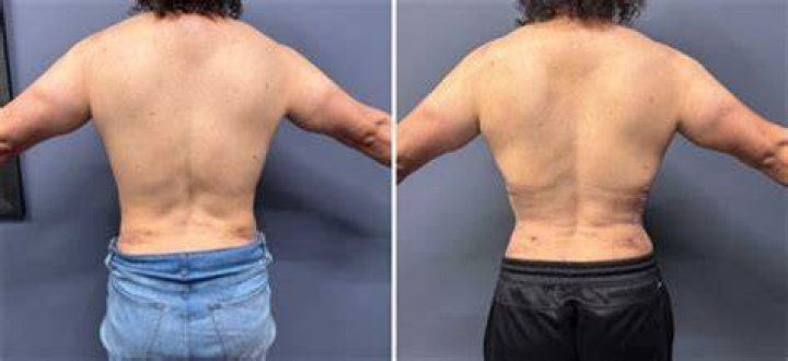 Rib Removal Before After: Understanding The Procedure And Its Implications