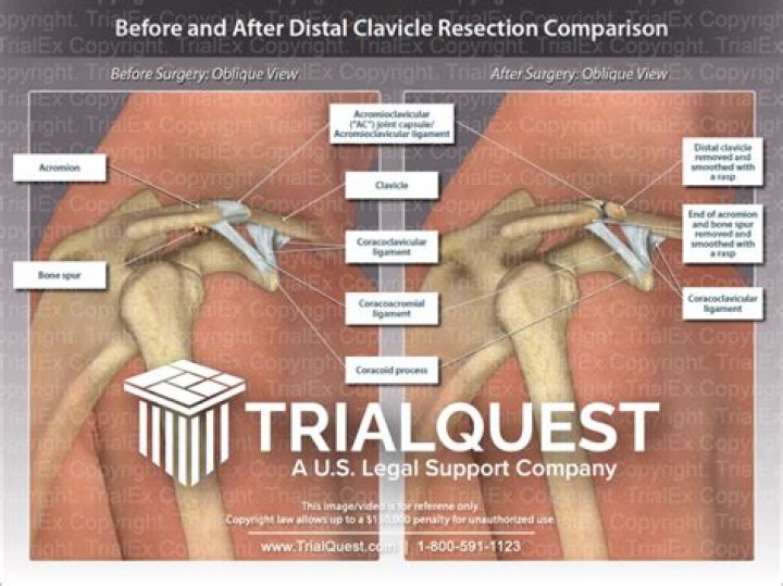 Shoulder Popping After Distal Clavicle Resection