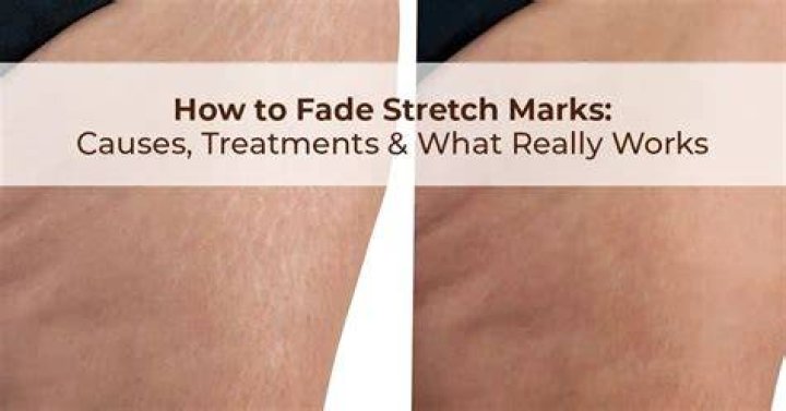 Stretch marks gel-to-oil with baobab oil