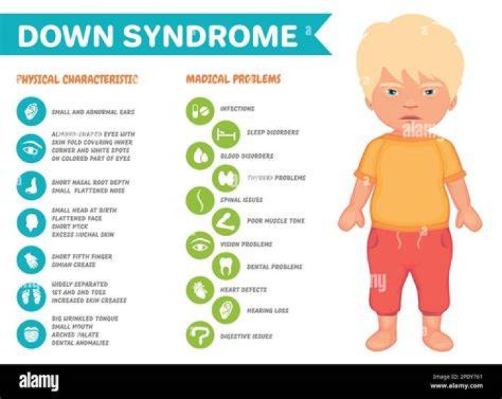 Symptoms of down syndrome vector infographic poster Stock Vector Image