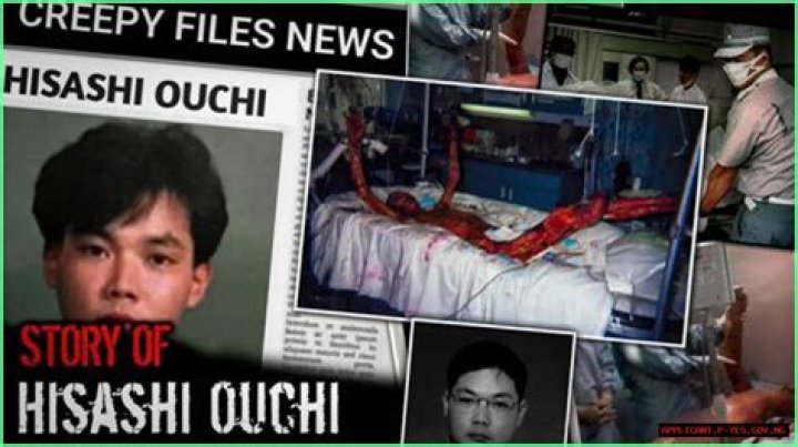 The Unseen Tragedy Hisashi Ouchi's Severe Facial Deformities