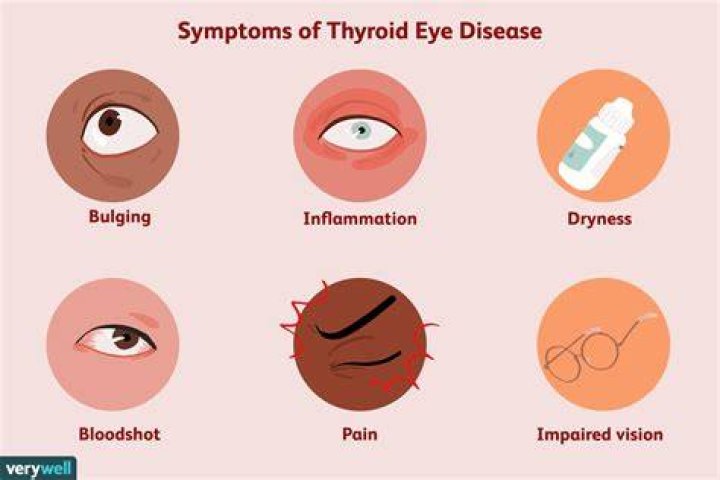 Thyroid Eye Disease Symptoms, Causes, and Treatment