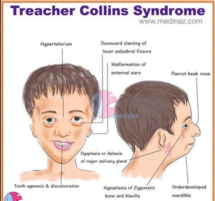 Treacher Collins Syndrome What Is Treacher Collins Syndrome?