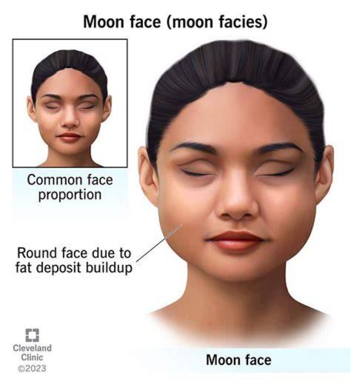 Understanding PCOS Moon Face - Statcare