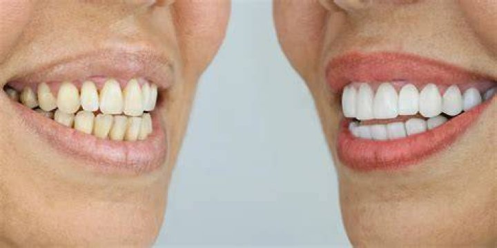 Unlock The Secrets Of Mark Few Teeth: Discoveries That Will Transform Your Smile