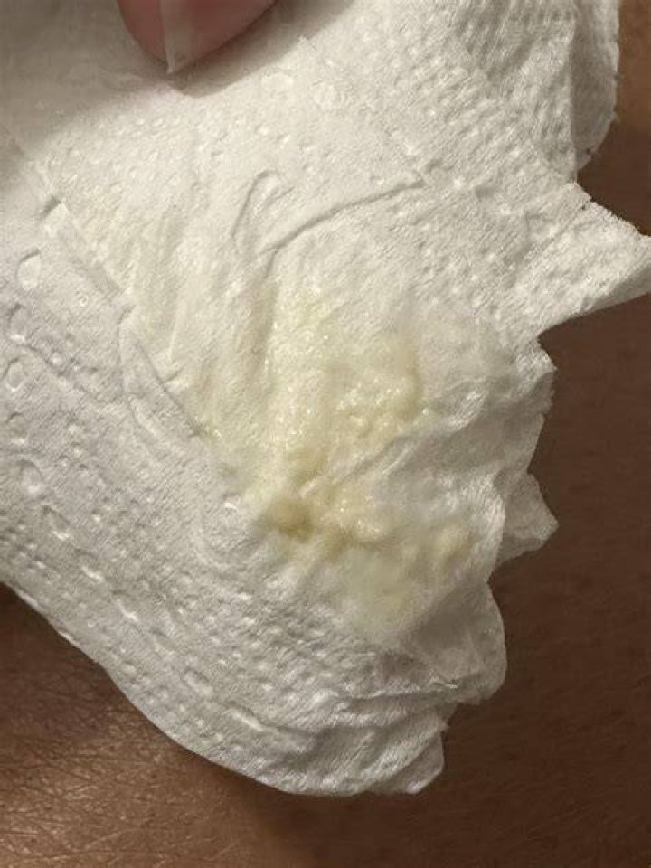 What Does It Mean When Discharge Looks Like Pieces Of Toilet Paper?