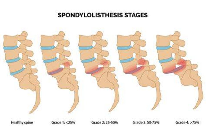What Grade Is A 4 Mm Anterolisthesis - Explained in Detail
