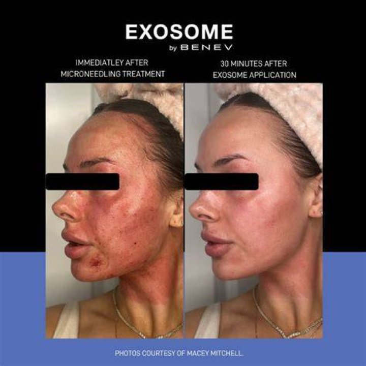 What Is Exosome Skin Care? Dermatologists Explain