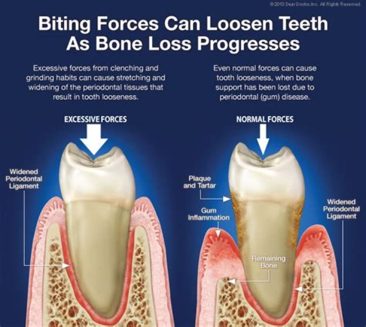 Why Do My Teeth Feel Loose?