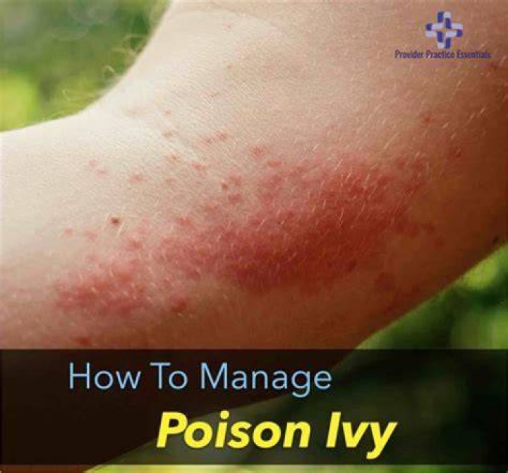 Why Does Hot Water Feel So Good On Poison Ivy